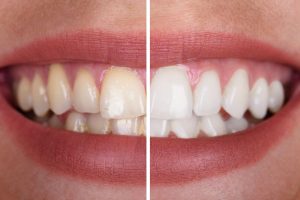 A before and after picture with stained teeth on the left and whiter teeth on the right.