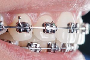 Teeth with dental braces
